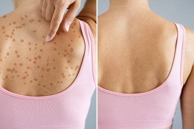 Hastalık Öncesinde Sedef Hastalığı. Dermatoloji Derisi Döküntüsü