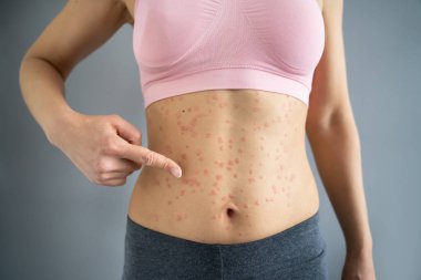 Otoimmün Sedef Hastalıklı Vücut Cildi. Tıbbi Hastalık