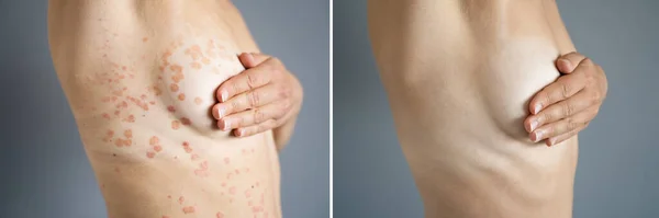 Psoriasis Enfermedad Tratamiento Antes Después Dermatología Erupción Cutánea —  Fotos de Stock