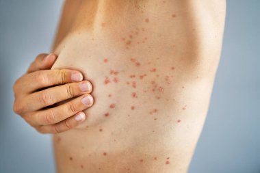 Kırmızı Alerji Patlamasıyla Kadın Cildi Kaşıntısı