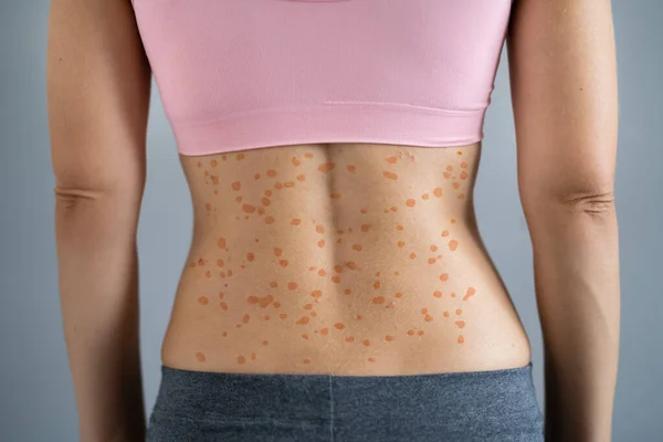 Donna Corpo Eruzione Cutanea Con Eruzione Allergica Rossa — Foto Stock