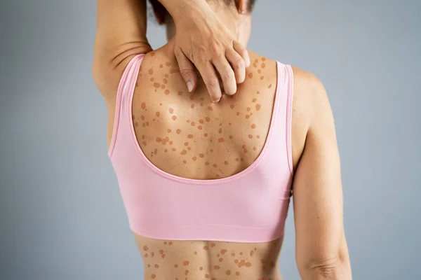 Eruzione Cutanea Prurito Alla Schiena Eczema Secco Allergia — Foto Stock