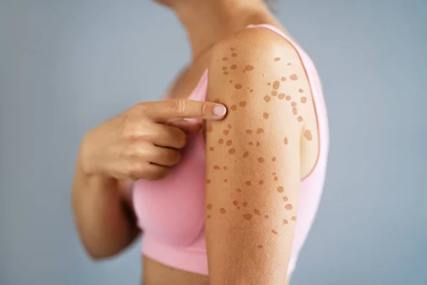 Donna Corpo Eruzione Cutanea Con Eruzione Allergica Rossa — Foto Stock