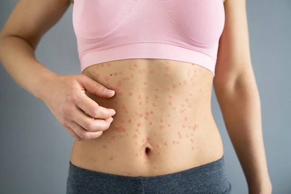 Kroppshud Med Psoriasis Autoimmun Sjukdom Sjukdom — Stockfoto