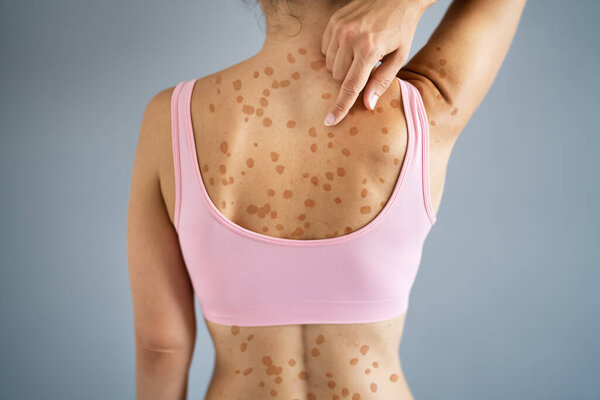 Сыпь на коже женщины с красной аллергией