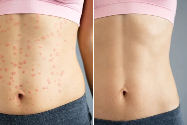 Psoriasis Sjukdom Behandling Före Efter Hudutslag Dermatologi — Stockfoto