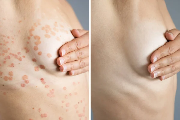 Peau Corporelle Avec Psoriasis Maladie Auto Immune Maladie Médicale — Photo