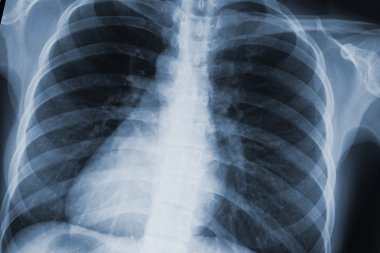 Göğüs xray tarama