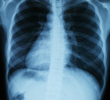 Göğüs xray tarama