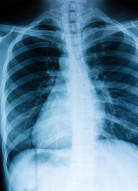 Göğüs xray tarama