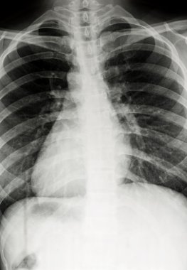 Göğüs xray tarama