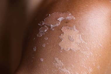 Male sunburned skin close up