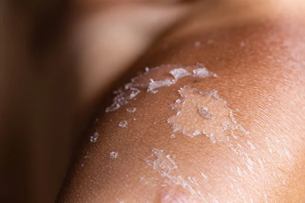 Peeling Skin Sunburn — Stok fotoğraf