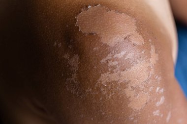 Male sunburned skin close up