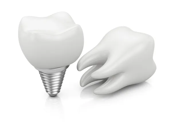 Tand en dental implant — Stockfoto