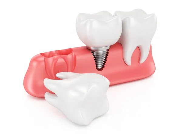 Conceito de implantação dentária — Fotografia de Stock