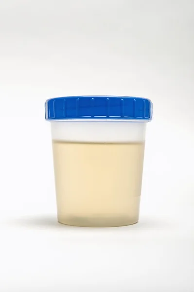 Échantillon d'urine dans un récipient en plastique — Photo