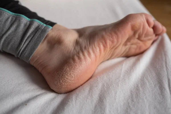 Болезнь кожи в сухую зиму, обезвоженная кожа на пятках женских ног — стоковое фото