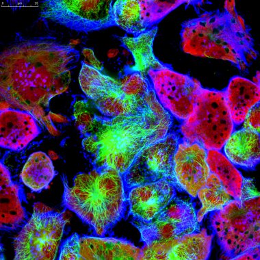 epitelyal tümör hücreleri floresan molekülleri ile Etiketlenmiş
