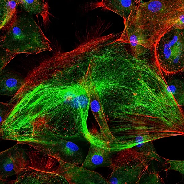 Epithel-Tumorzellen mit fluoreszierenden Molekülen markiert — Stockfoto