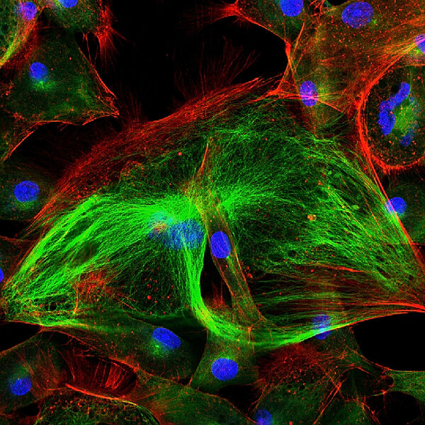 Epithelial tumor cells labeled with fluorescent molecules