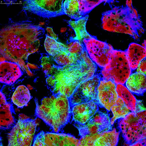 Epithelial tumor cells labeled with fluorescent molecules