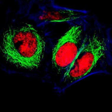epitelyal tümör hücreleri floresan molekülleri ile Etiketlenmiş