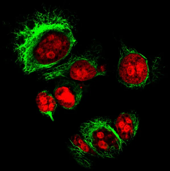 Epitelyal tümör hücreleri floresan molekülleri ile Etiketlenmiş — Stok fotoğraf