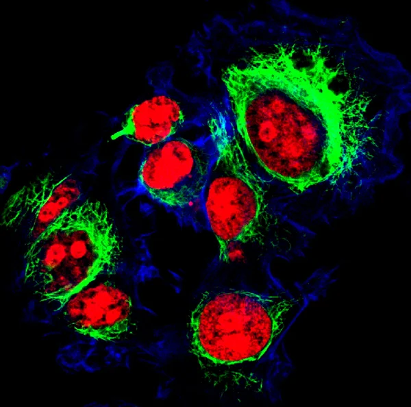 Komórki nabłonka guza naklejona etykietka rezygnować fluorescencji molekuł — Zdjęcie stockowe