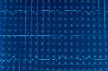 EKG Elektrokardiyogram