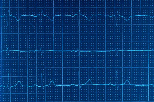 EKG Elektrokardiyogram