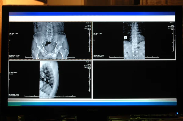 Röntgenbild des Beckens — Stockfoto