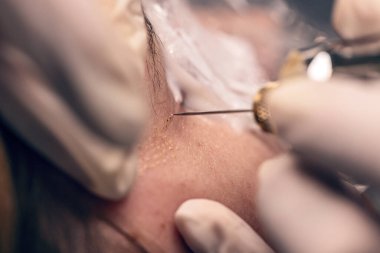 Plazma fibroblast tekniğiyle gözler için cerrahi olmayan kozmetik prosedürler