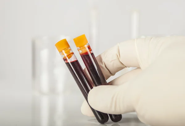 Hand holding blood sample — Stock Photo, Image