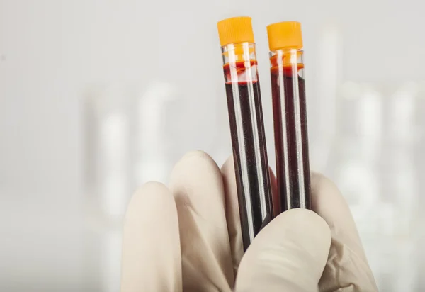 Mão segurando amostra de sangue — Fotografia de Stock