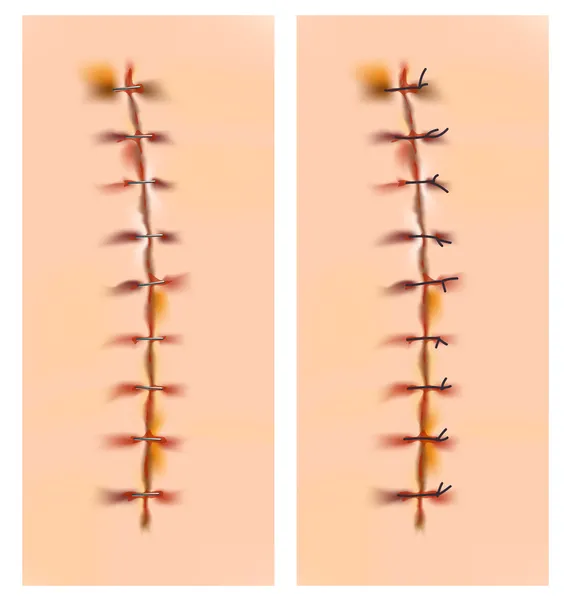 Cicatrices avec agrafes et sutures . — Image vectorielle