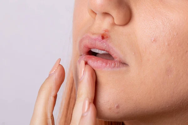 Close Ein Virus Herpes Auf Den Lippen Frauen — Stockfoto