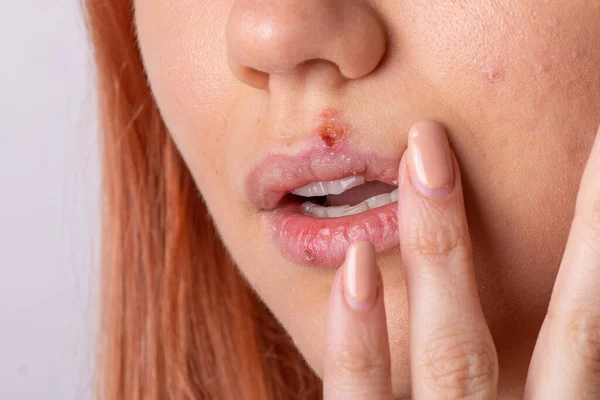 Feche Herpes Vírus Mulheres Lábios — Fotografia de Stock