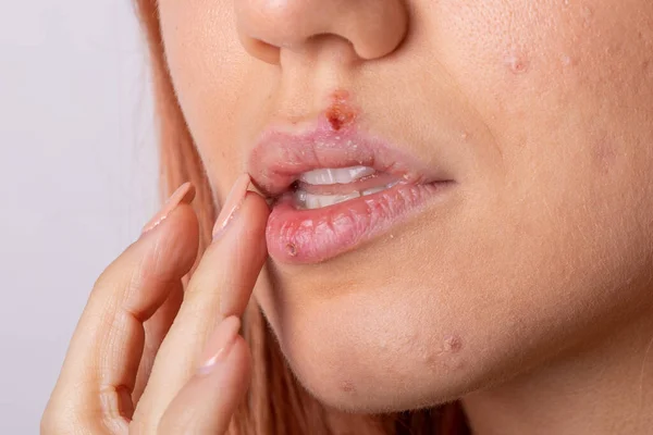 Close Virus Herpes Lips Women — Stock Photo, Image