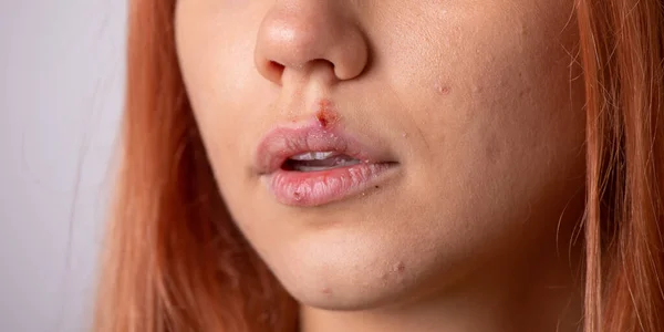 Close Virus Herpes Lips Women — Stock Photo, Image
