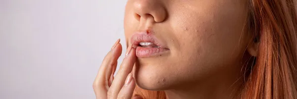 Feche Herpes Vírus Mulheres Lábios — Fotografia de Stock