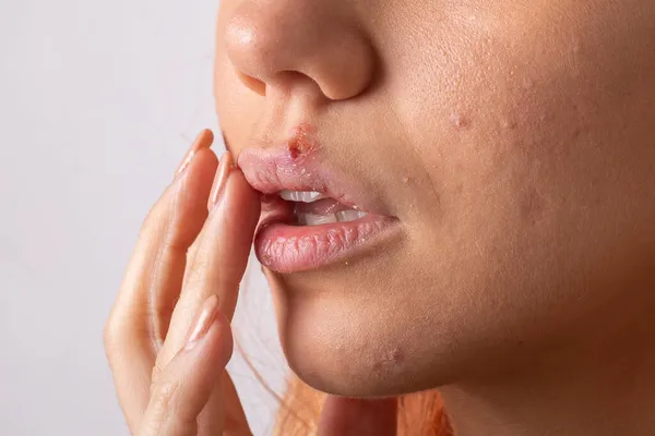 Close Virus Herpes Lips Women — Stock Photo, Image