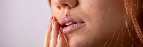 女性嘴唇上闭上病毒疱疹 — 图库照片