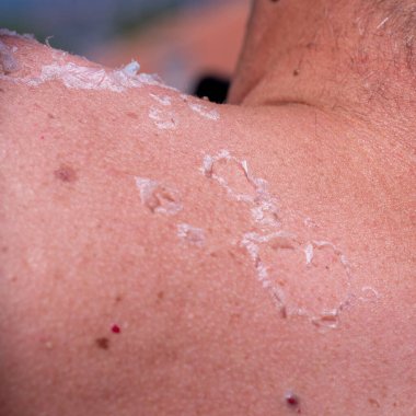 Sırtında ve omuzlarında yanmış güneş yanığı fotoğrafı var.