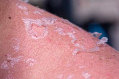 Sırtında ve omuzlarında yanmış güneş yanığı fotoğrafı var.