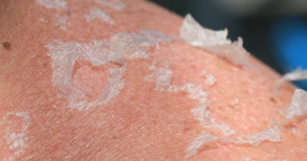 Sunburn Closeup Peeling Sunburned Skin Back Shoulder Spending Time Sun — Stock Video