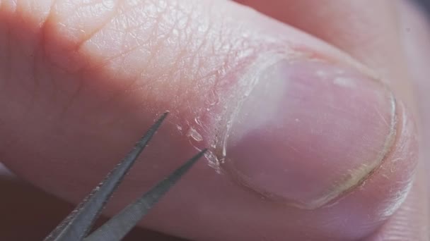 Proceso Extracción Las Uñas Colgar Usando Las Tijeras Dedo Masculino — Vídeo de stock