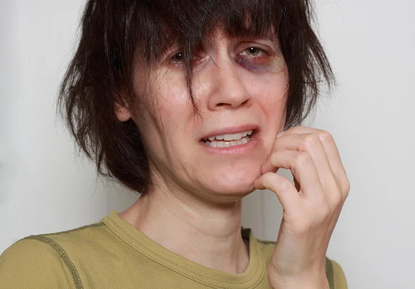 Sad woman with black eye — Stock Photo, Image