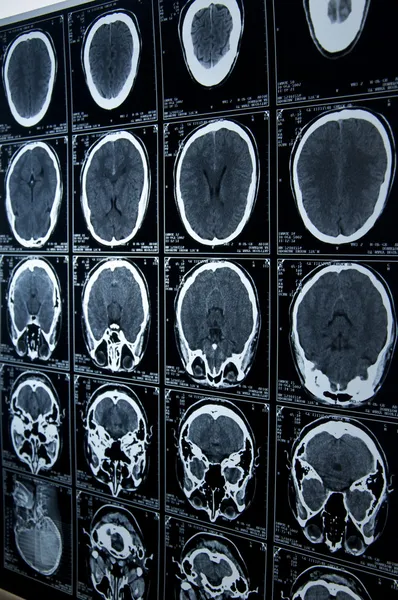 MRI hersenscan — Stockfoto