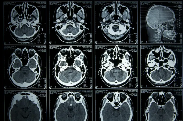 磁共振成像扫描大脑 免版税图库照片